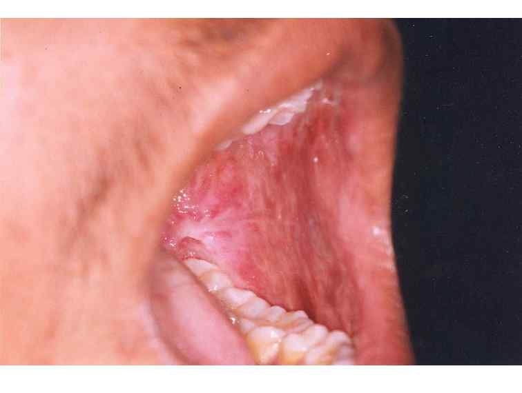 poza despre ulcer bucal